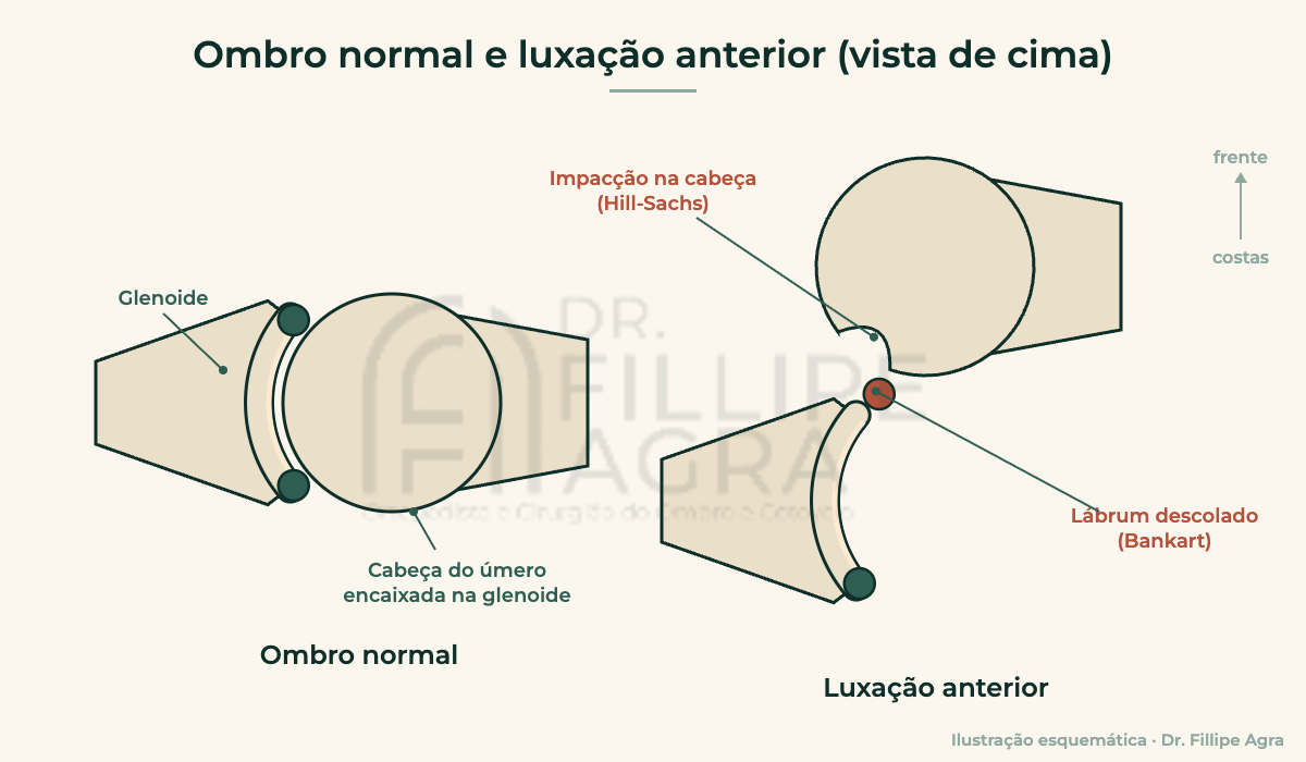 Ilustração do ombro normal e da luxação anterior do ombro, com lesão de Bankart e de Hill-Sachs